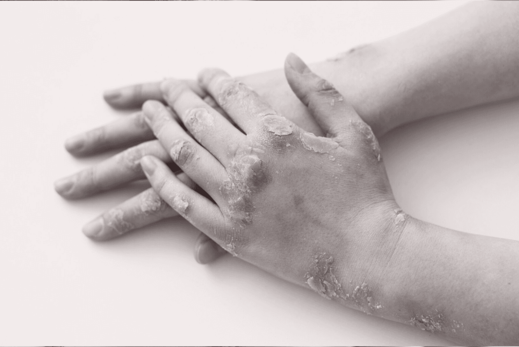 psoriasis, eczéma